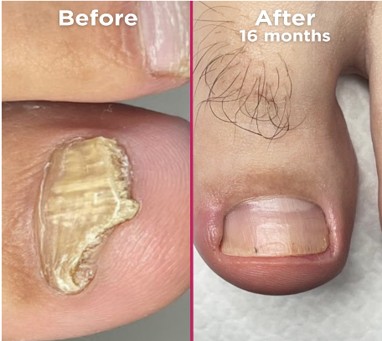 Footlogix Nail Tincture